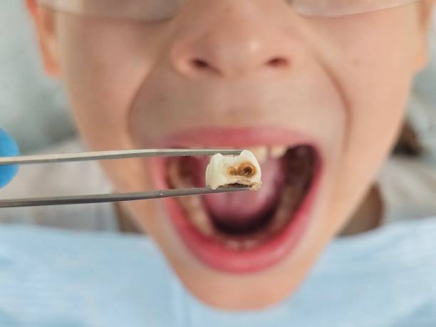 Best Emergency Wisdom Teeth Removal in Sudan, TX